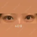 二重切開 / 眼瞼下垂（切開） / 上まぶたたるみ取り eクリニック 福岡院 DAY 5 サムネイル用