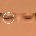 二重切開 / 眼瞼下垂（切開） / 上まぶたたるみ取り eクリニック 福岡院 DAY 5 サムネイル用