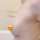 豊胸（シリコン＋脂肪併用） BUST CLINIC（バストクリニック） 東京 DAY 182 サムネイル用