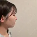 糸リフト / バッカルファット除去 / 脂肪吸引（顔） / メーラーファット除去 / ジョールファット除去 / ボトックス（あご） First Clinic DAY 91 サムネイル用