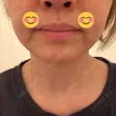 ハイフ（顔） 城本クリニック 高崎院 AFTER サムネイル用