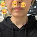 ハイフ（顔） 城本クリニック 高崎院 DAY 0 サムネイル用