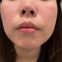 脂肪溶解注射（顔） BAO CLINIC 神戸院 DAY 1 サムネイル用