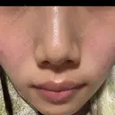 フォトRF 湘南美容クリニック 長野院 DAY 5 サムネイル用