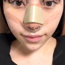 隆鼻術 / 軟骨移植 / 鼻尖形成（非切開） / 鼻中隔延長（非切開） WOM CLINIC GINZA （ワム クリニック ギンザ） DAY 7 サムネイル用