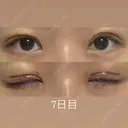二重切開 / 眼瞼下垂（切開） / 上まぶたたるみ取り eクリニック 福岡院 DAY 6 サムネイル用