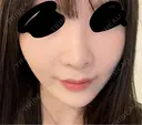 鼻中隔延長（切開） / その他（鼻） / 軟骨移植 / 鼻孔縁下降 / 鼻柱下降・鼻唇角形成（猫手術） KIHARU CLINIC DAY 19 サムネイル用