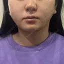 糸リフト / 脂肪吸引（顔） / ジョールファット除去 Wing clinic 豊中駅前院 DAY 1 サムネイル用