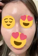 フラクショナルレーザー（毛穴・ニキビ跡） おおかみ美容のクリニック 新宿院 DAY 1 サムネイル用