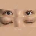 二重切開 / 眼瞼下垂（切開） / 上まぶたたるみ取り eクリニック 福岡院 DAY 7 サムネイル用