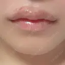 ヒアルロン酸注入（唇） / ボトックス（口角） PRO CLINIC プロクリニック 銀座院 DAY 7 サムネイル用