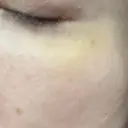 ボトックス（目尻） PRO CLINIC プロクリニック 銀座院 DAY 6 サムネイル用