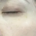 ボトックス（目尻） PRO CLINIC プロクリニック 銀座院 DAY 9 サムネイル用