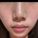 フォトRF 湘南美容クリニック 長野院 AFTER サムネイル用