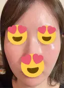 フラクショナルレーザー（毛穴・ニキビ跡） おおかみ美容のクリニック 新宿院 DAY 2 サムネイル用