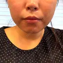 脂肪溶解注射（顔） BAO CLINIC 神戸院 DAY 3 サムネイル用