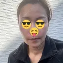 切開リフト GRACY TOKYO CLINIC【グレイシートウキョウクリニック】 AFTER サムネイル用