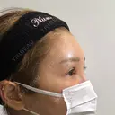 脂肪注入（額） plume clinic DAY 30 サムネイル用