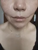 その他 MKクリニック 日本橋院 AFTER サムネイル用