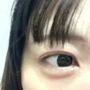 人中短縮 / 小鼻縮小（非切開） / ヒアルロン酸注入（涙袋） / ヒアルロン酸注入（唇） / ヒアルロン酸注入（目の下） / ボトックス（人中） Evergreen medical clinic AFTER サムネイル用