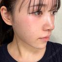 隆鼻術 / 軟骨移植 / 鼻尖形成（非切開） / 鼻中隔延長（非切開） WOM CLINIC GINZA （ワム クリニック ギンザ） DAY 9 サムネイル用