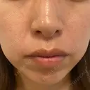その他（肌） エースクリニック 大阪梅田HEPナビオ院 DAY 7 サムネイル用