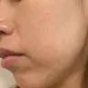 その他（肌） エースクリニック 大阪梅田HEPナビオ院 DAY 7 サムネイル用