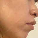 その他（肌） エースクリニック 大阪梅田HEPナビオ院 DAY 7 サムネイル用
