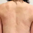 ピコフラクショナルレーザー（毛穴・ニキビ跡） ルラ美容クリニック 広島院 DAY 5 サムネイル用