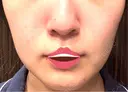 脂肪吸引（顔） 湘南美容クリニック 渋谷院 AFTER サムネイル用