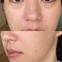 ヴェルヴェットスキン RainBoW Clinic TOKYO AFTER サムネイル用