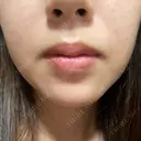 ハイフ（顔） 共立美容外科 大阪本院 DAY 3 サムネイル用