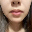 ハイフ（顔） 共立美容外科 大阪本院 DAY 4 サムネイル用