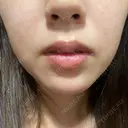 ハイフ（顔） 共立美容外科 大阪本院 DAY 5 サムネイル用