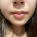 ハイフ（顔） 共立美容外科 大阪本院 DAY 6 サムネイル用