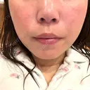 脂肪溶解注射（顔） BAO CLINIC 神戸院 DAY 4 サムネイル用