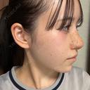 隆鼻術 / 軟骨移植 / 鼻尖形成（非切開） / 鼻中隔延長（非切開） WOM CLINIC GINZA （ワム クリニック ギンザ） DAY 10 サムネイル用