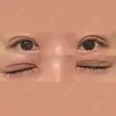 二重切開 / 眼瞼下垂（切開） / 上まぶたたるみ取り eクリニック 福岡院 DAY 10 サムネイル用