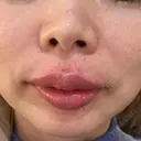 ヒアルロン酸注入（唇） KIMI CLINIC 形成・美容外科 DAY 0 サムネイル用