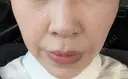 ヒアルロン酸注入（頬） ルラ美容クリニック 岡山院 AFTER サムネイル用