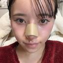 隆鼻術 / 軟骨移植 / 鼻尖形成（非切開） / 鼻中隔延長（非切開） WOM CLINIC GINZA （ワム クリニック ギンザ） AFTER サムネイル用