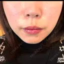 脂肪溶解注射（顔） BAO CLINIC 神戸院 DAY 6 サムネイル用