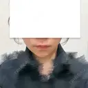 バッカルファット除去 / メーラーファット除去 / ボトックス（あご） / ヒアルロン酸注入（あご） First Clinic AFTER サムネイル用