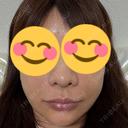 ピーリング（ハリ・ツヤ） Sea Sail Beauty Clinic AFTER サムネイル用