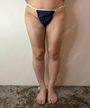 脂肪吸引（顔） / 脂肪吸引（脚） / 脂肪吸引（お尻） GAYA body design clinic AFTER サムネイル用