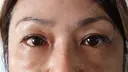 下まぶたたるみ取り 湘南美容クリニック 千葉センシティ院 DAY 28 サムネイル用