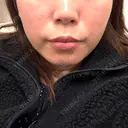 脂肪溶解注射（顔） BAO CLINIC 神戸院 AFTER サムネイル用