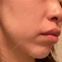 その他（肌） エースクリニック 大阪梅田HEPナビオ院 DAY 11 サムネイル用