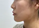 ヒアルロン酸注入（鼻） / ボトックス（あご） / ヒアルロン酸注入（唇） / ボトックス（口角） / ボトックス（人中） / ヒアルロン酸注入（鼻翼基部） EMMO FACE CLINIC 大阪梅田院 AFTER サムネイル用