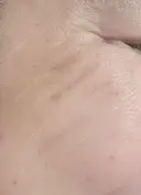 ボトックス（眉間） / ボトックス（目尻） / ボトックス（額） DMTC美容皮膚科 大宮院 DAY 22 サムネイル用